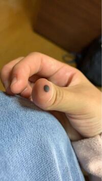 5日ほど前に指を挟んでしまい 血豆ができたのですが 治る気配がなく未だ Yahoo 知恵袋