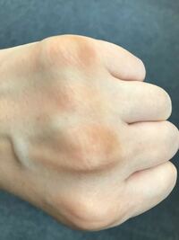 皮膚の黒ずみは治りますか 最近 手の指の付け根の骨の付近の皮膚が Yahoo 知恵袋