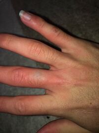 恥ずかしい話ですが壁を殴ってしまいこうなりました これは骨折ですか 教えて 住まいの先生 Yahoo 不動産