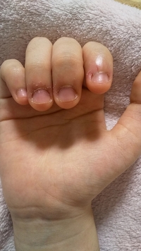 画像注意 こんにちは 高一女子です 私は小学生から爪を噛む Yahoo 知恵袋