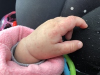 赤ちゃんの手 足に湿疹が出ています 手のひらには出てなく 口にも出てい Yahoo 知恵袋