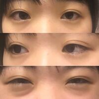 16歳の高校生です 昔から涙袋の下のたるみに悩んでいました 友達 Yahoo 知恵袋