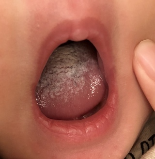 舌 白い 赤ちゃん