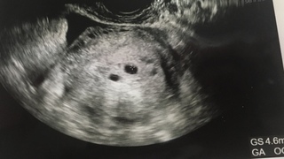 5週3日で双子の可能性がありますと言われました 自然妊娠です 前回8週 Yahoo 知恵袋