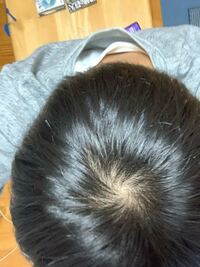 光の下だと頭皮がすけて見えるのって普通ですか Yahoo 知恵袋