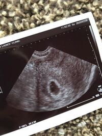 現在妊娠5w6dです 先日 病院で胎嚢確認できたのですが先生には Yahoo 知恵袋