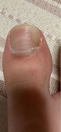 足の親指の爪の一部分が白くなって剥がれていました 痛みや痒みなど Yahoo 知恵袋