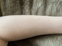 荒れた肌の写真があります ご注意下さい 画像のように 白っ Yahoo 知恵袋