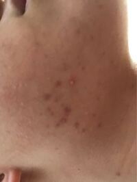 閲覧注意僕はフェイスラインのニキビ跡に悩んでい ます 皮膚科に行く Yahoo 知恵袋