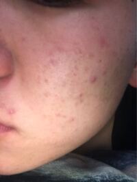 中学三年生です。中2くらいからニキビができ始めて今この状態で... - Yahoo!知恵袋