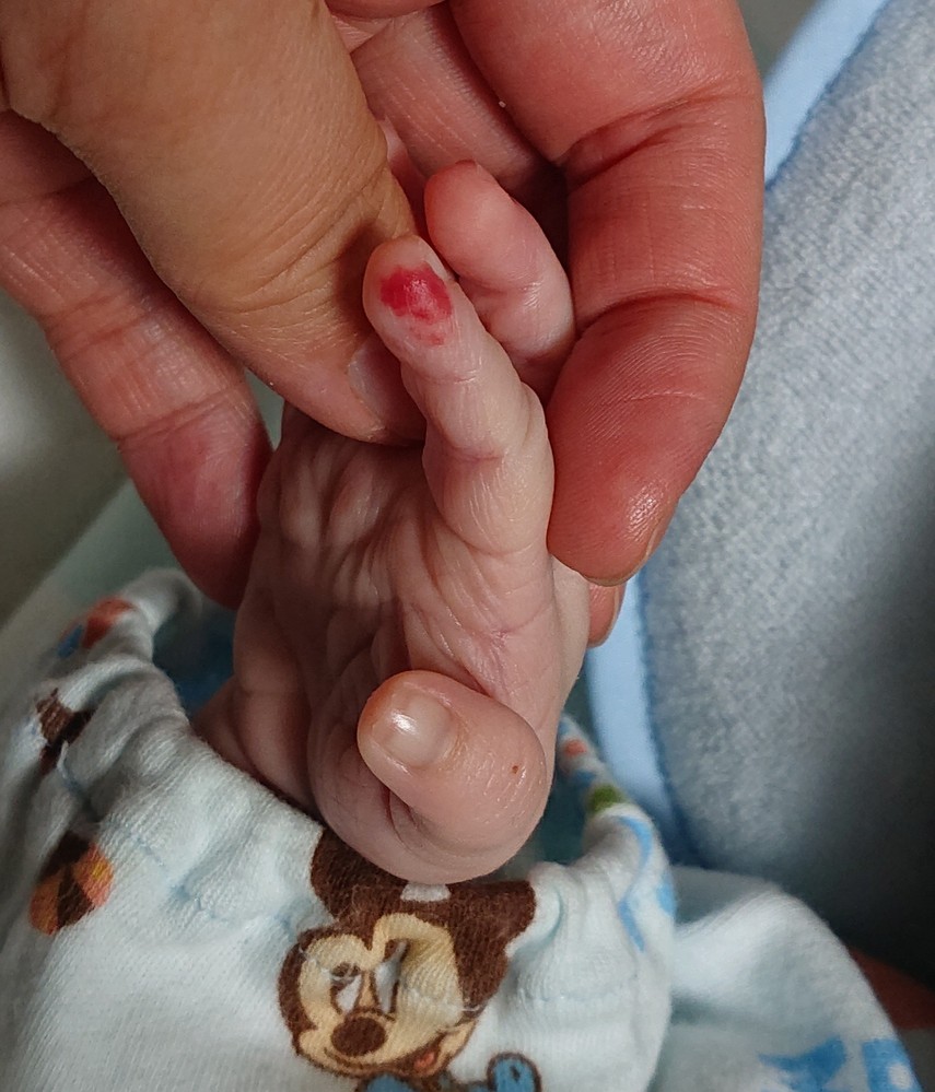 生後３週間の赤ちゃんです 最近人差し指の爪の横が赤いのですがこれは何で Yahoo 知恵袋
