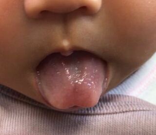 赤ちゃんの舌が割れてるのが気になります 生後1ヶ月半です 病院で Yahoo 知恵袋
