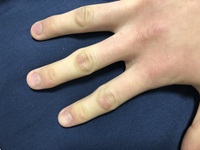 10代男です1年ほど前から右手人差し指の第2関節にタコ Yahoo 知恵袋
