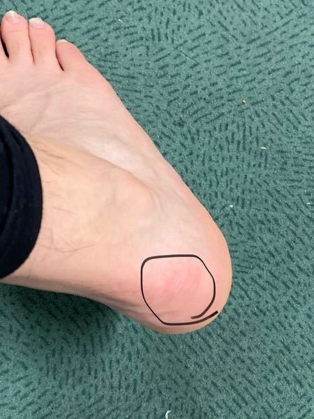 スノーボードをしたら後ろ側の足のかかとの外側(赤くなってる場所)がブー... - Yahoo!知恵袋