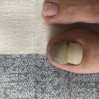 の 臭い の 足 親指 爪 写真付き！足の爪の変形や変色の理由って？巻き爪 、爪甲鉤彎症、爪白癬…症状と原因、治療、予防法