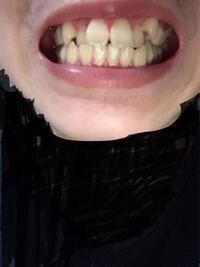 歯並びが悪いけど可愛い人っていますよね むしろ可愛い人って歯並びが悪い Yahoo 知恵袋