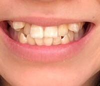 八重歯について 私は今高校1年生で小4ぐらいから八重歯が Yahoo 知恵袋