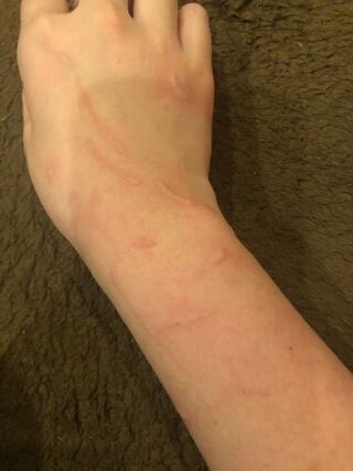 ベストコレクション 猫 引っ掻き傷 腫れ 3087 猫 引っ掻き傷 腫れ