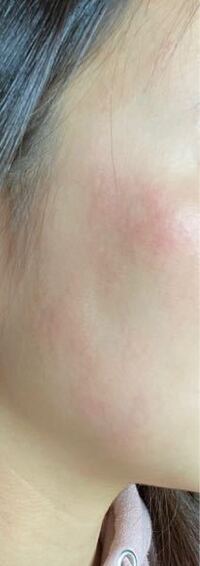 昨日から顔の湿疹がひどいのですが これにスピラゾンを一面に塗っても大丈 Yahoo 知恵袋