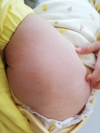 生後９ヶ月になる赤ちゃんを育てていますが 足の付け根周りの肌が荒れて心 Yahoo 知恵袋