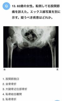歳の女性 転倒して右股関節痛を訴えた エックス線写真を参 Yahoo 知恵袋