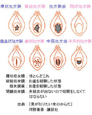 中隔処女膜 に関するq A Yahoo 知恵袋