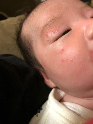 生後1ヶ月ちょっとの女の子です 昨夜から右目まぶたに小さな赤いぶ Yahoo 知恵袋