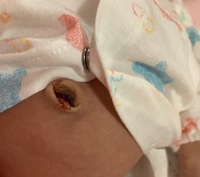 生後11日目の赤ちゃん 新生児のおへそについての質問です 1 Yahoo 知恵袋