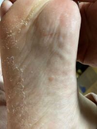 これはかかと水虫でしょうか かゆみ 痛みは全くありませ Yahoo 知恵袋