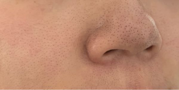 閲覧注意です この頬 特に鼻 の黒い点々がとても気にな Yahoo 知恵袋