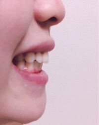 抜歯矯正したのに出っ歯です 4本抜歯して矯正しました 歯は綺麗に Yahoo 知恵袋