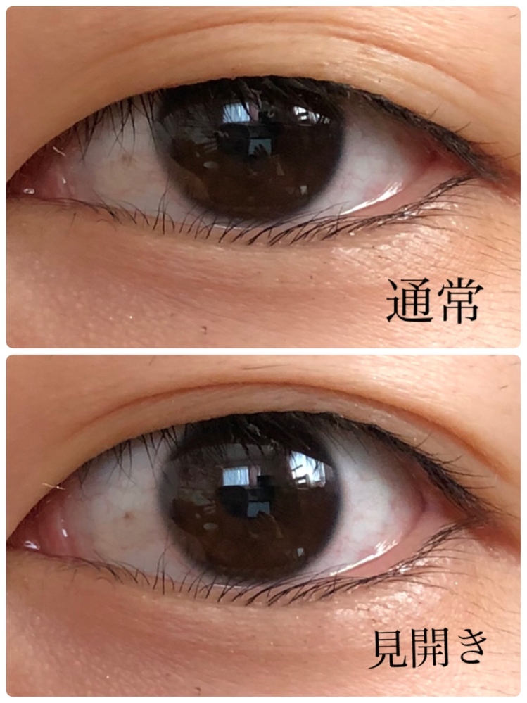 通常状態では一重なのに目を見開くと線のようなシワのようなものが入り 