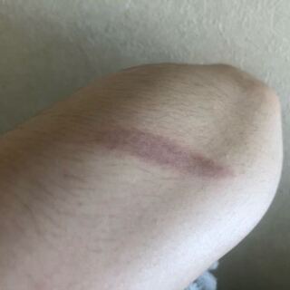 やけど 処置 花火