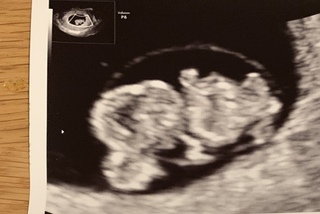 妊娠３ヶ月 9週目のエコー写真です まだまだ性別判断するには早すぎる時 Yahoo 知恵袋