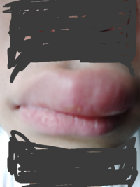 至急朝起きたら唇が写真のように晴れていました 腫れた部分は痛み痒 Yahoo 知恵袋