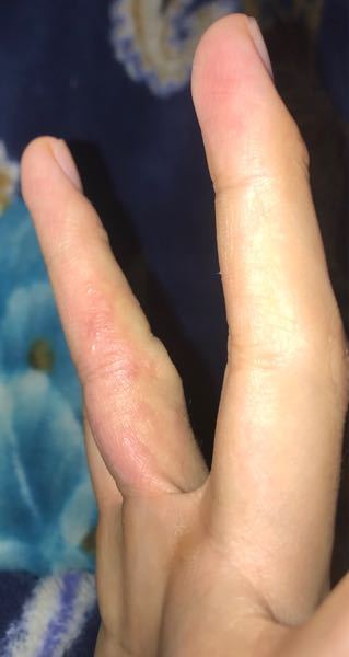 手湿疹 水泡 つぶす 知恵袋