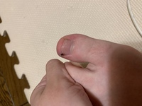 とにかく足の指が痛い 足の親指の爪の1番左側が押すと痛いです どうすれ Yahoo 知恵袋