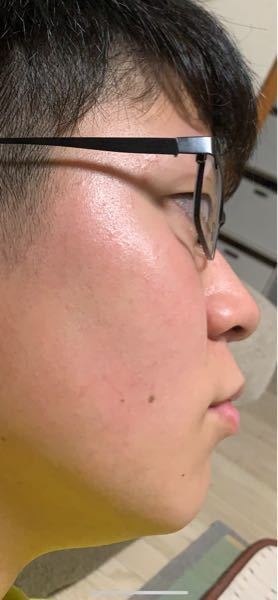 すみません これはアデノイド顔貌でしょうか 診断お願いします Yahoo 知恵袋
