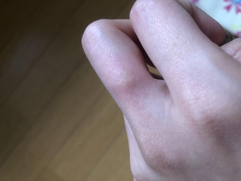 生理前とかの体調があんまり良くない時にいつもどこかの指にとて Yahoo 知恵袋