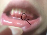歯茎 痛い 白い腫れ