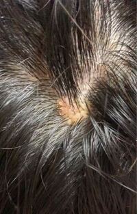 頭皮にこんなものができてました 痛みや痒みなどはありません 不安 Yahoo 知恵袋