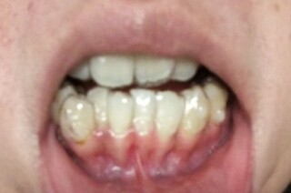歯茎 歯 が 透け て 見える