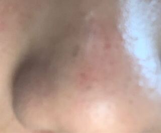 毛穴の黒ずみが全くなおりません 洗顔は泡だてて優しく Yahoo 知恵袋