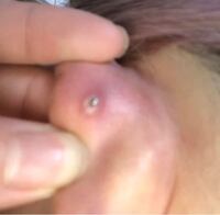 ピアスについてです これは初期の肉芽ですか 画像 1ヶ月前に軟骨 Yahoo 知恵袋