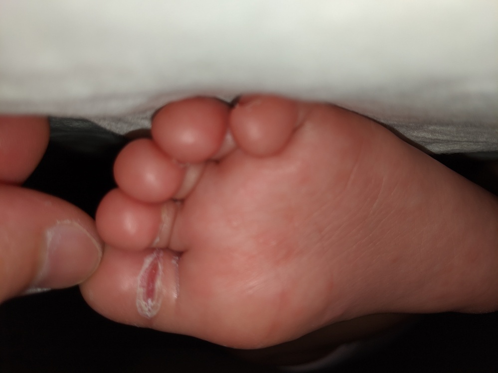 生後9ヶ月の赤ちゃんの足です 付け根がぱっくり割れてしまって Yahoo 知恵袋