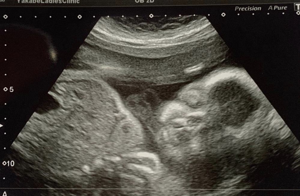 妊娠30週です 赤ちゃんのエコー写真を見て 口唇裂じゃないかとふと不安 Yahoo 知恵袋