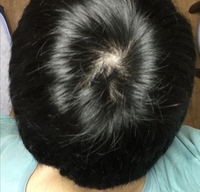 このツムジはハゲているように見えますか 悩んでいます Yahoo 知恵袋