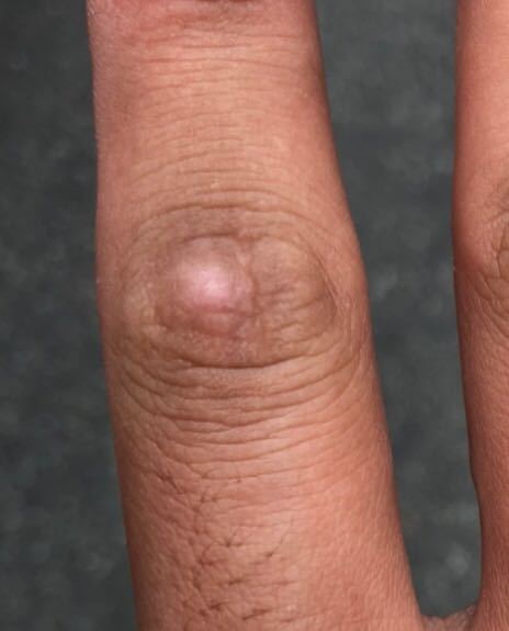 2年ほど前に指にイボみたいなものができてしまいました。イボなのか 