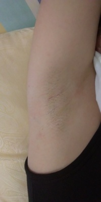 閲覧注意です 高校2年生の女子です 脇毛が太く 濃くて悩んでい Yahoo 知恵袋