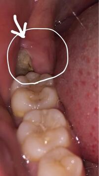 どうすればいいの 痛む親知らず 原因と対処法 秋津歯科 矯正歯科 秋津の歯医者